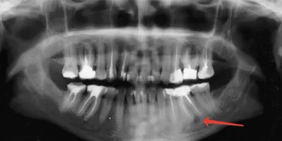 Хирургическое удаление кисты, гранулемы зуба, операция цистэктомия с  резекцией верхушки корня