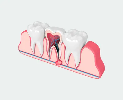 Киста после удаления зуба — симптомы и лечение
