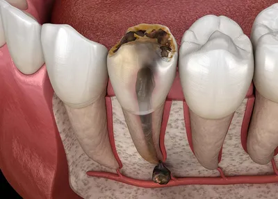 Киста на десне зуба фото фото