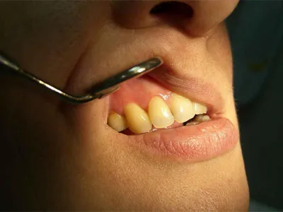 Киста зуба | Удаление кисты зуба - цена в 32Dent