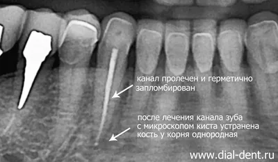 Киста Зуба (Что Это Такое) Как Лечить 100% информации