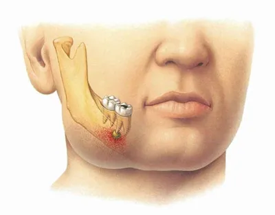 Диагностика и лечение — киста зуба
