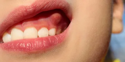 Лечение кисты зуба в Днепре | Стоматологія \"Полімед\"
