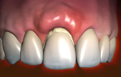 Киста зуба: методы лечения, цены, симптомы воспаления — ROOTT
