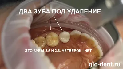 Лечение кисты зуба в Москве, описание методов и цены | «Вита-Стом»