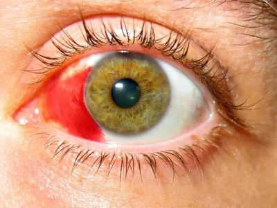 Киста конъюнктивы глаза - лечение без операции