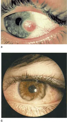 Патологические изменения поверхности глазного яблока — Teletype