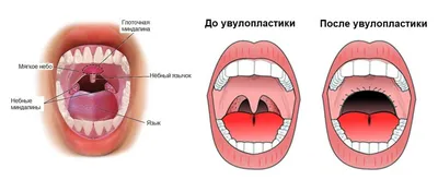 Хирургия мягкого нёба для лечения храпа (увулопластика) в Минске