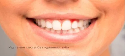 Удаление кисты без удаления зуба [хирургический метод]