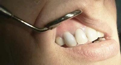 Удаление кисты зуба у взрослых