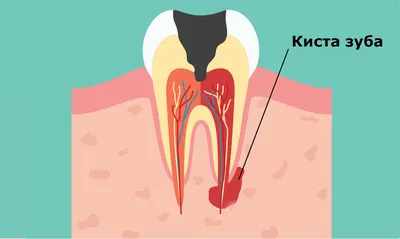 Что такое киста зуба, её симптомы и способы лечения