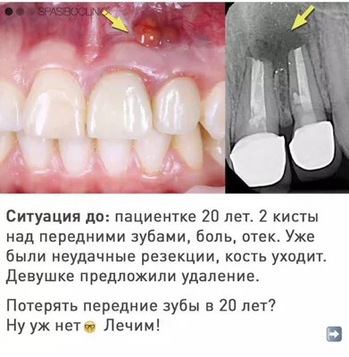 Шишка на десне: что это такое, причины и лечение — Экспертные статьи на  сайте стоматологии АРТ