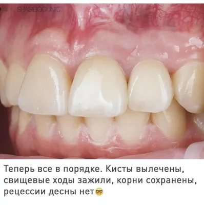 Рак мягкого и твердого неба - лечение и операция в Москве