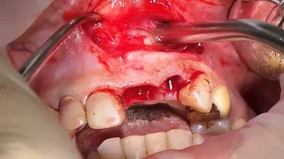 Абсцесс зуба - что это такое, причины, симптомы, диагностика, лечение  (удаление, вскрытие)