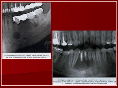 Цистэктомия (операция по удалению кисты зуба) - Медицинский центр «ЛОДЭ»
