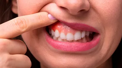 Ретенционные кисты – что это такое ⁉️ Довольно часто к стоматологу  обращаются пациенты с жалобами на неожиданно появившийся «шарик» на… |  Instagram
