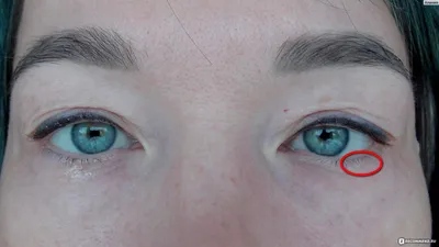 Покраснение глаз - когда нужно обратиться к врачу | Украинский  офтальмологический портал