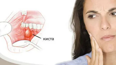 Можно ли спасти зуб с кистой от удаления? - atlantida74.ru