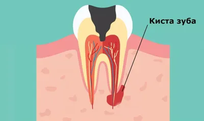 Киста зуба и имплантация - Cтоматология Май