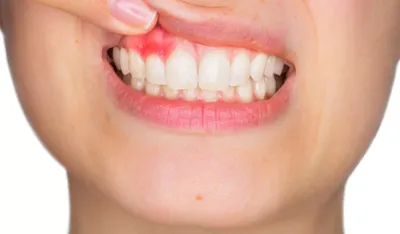 Удаление кисты зуба верхней и нижней челюсти в Гомеле