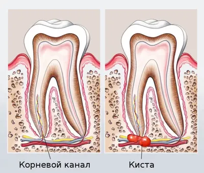 Киста зуба - определение патологии, причины возникновения, виды кист,  симптомы, диагностика и лечение