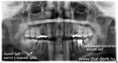 Лечение кисты зуба СПб | Стоматология Василенко