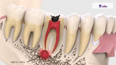 Лечение кисты зуба в Днепре | Стоматологія \"Полімед\"