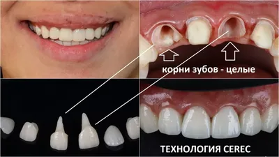 Можно ли ставить имплант при кисте в удаленном зубе