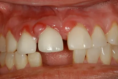 Киста зуба, обнаруженная на компьютерной томограмме зубов