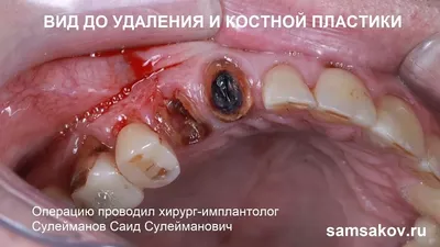 Когда корень зуба удалять, а когда восстанавливать зуб? - Немецкий  Имплантологический Центр, Москва