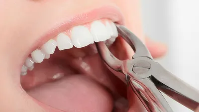 Лечение кисты зуба в Майами