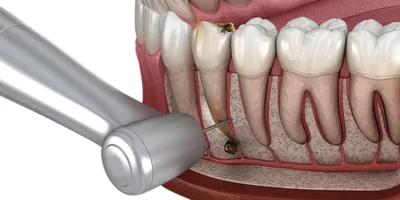 Спасение переднего зуба с «кистой» путем апикальной микрохирургии - Polar  Bear General Dental Clinic