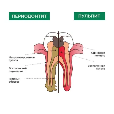 Срочное лечение кисты зуба в Москве