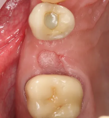 Временный протез после удаления зуба