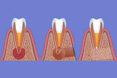 Киста зуба, Магнитогорск, лечение и удаление | Стоматология Риадент