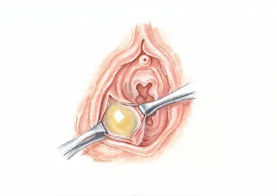 Воспаление бартолиновой железы у женщин | Лечение кист и абсцессов  бартолиновой железы