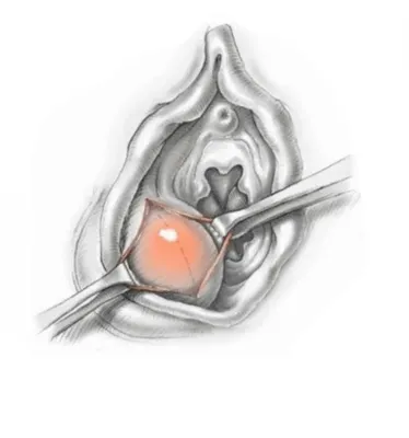 Лечение кисты бартолиновой железы в Хабаровске в Медикъ