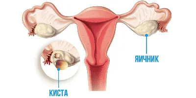 Виды кист яичников у женщин - какие бывают? - Хирург К. В. Пучков