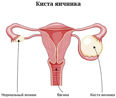 Киста яичника — лечение, причины, симптомы и диагностика