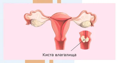 Удаление кисты влагалища в Москве, цена операции в клинике АльтраВита