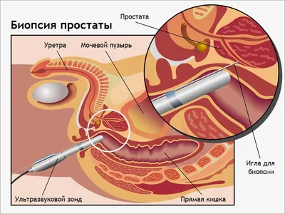 Рак простаты у мужчин - симптомы, причины и стадии рака предстательной  железы