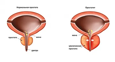 Лечение кисты предстательной железы у мужчин в клинике ЕЦС