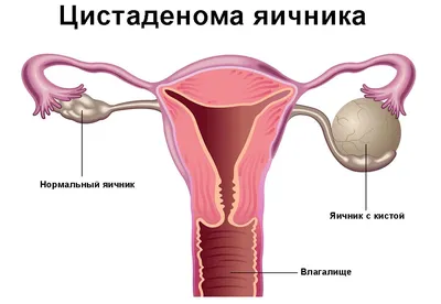 Рак вульвы: симптомы, диагностика, лечение, стадии и профилактика онкологии  половых губ