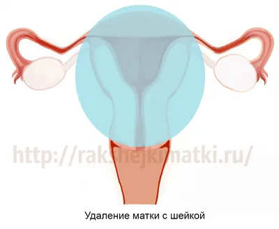 Киста копчика (эпителиальный копчиковый ход)