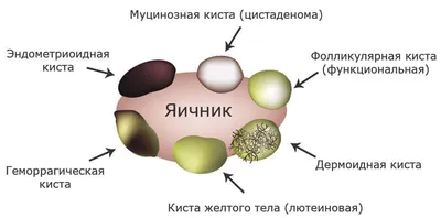 ЭНДОМЕТРИОЗ симптомы и лечение | Клиника лечения эндометриоза