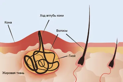 Что такое эпидермальная киста кожи: удаление подкожной кисты в Лазерсвiт