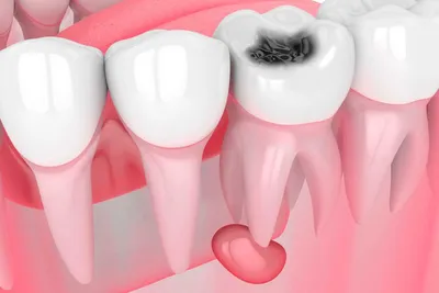 Киста зуба - Стоматология Северное Бутово Делия только качественные услуги