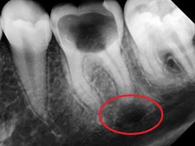 ᐈ Киста в десне зуба: последствия, чем опасна для человека