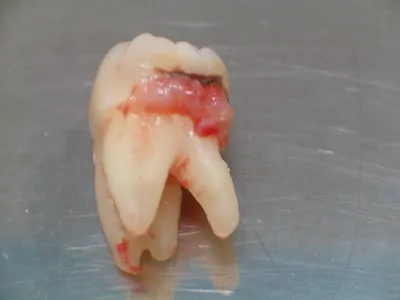 Лечение кисты зуба Стоматология №2 в Ижевске