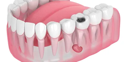 Удаление зуба с кистой на корне — показания, как происходит процедура, боль  при удалении